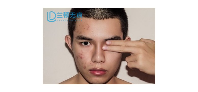 兰顿无痕疤痕体制饮食的建议